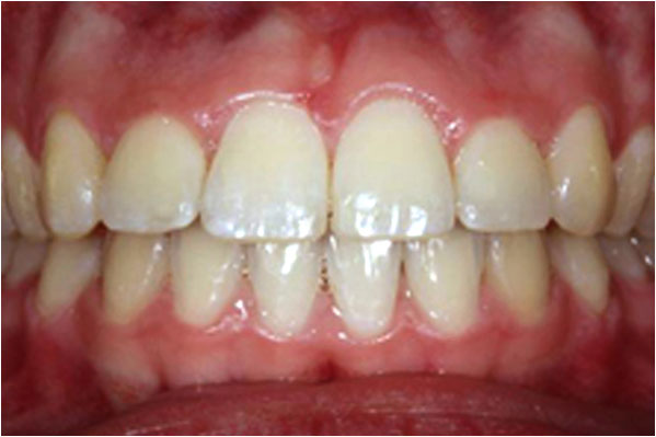 Orthodontics After 