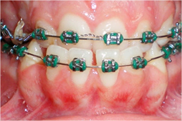 Orthodontics Before